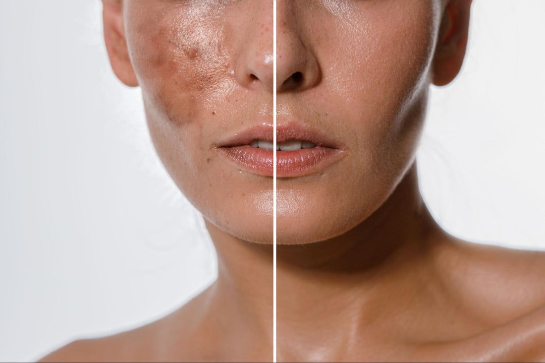 Time to Glow: Understanding and Treating Skin Pigmentation